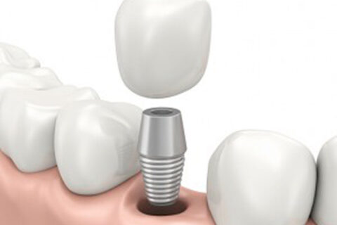 Dental Implant