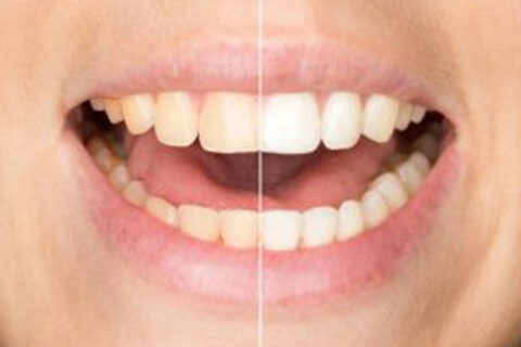 tooth before and after treatment